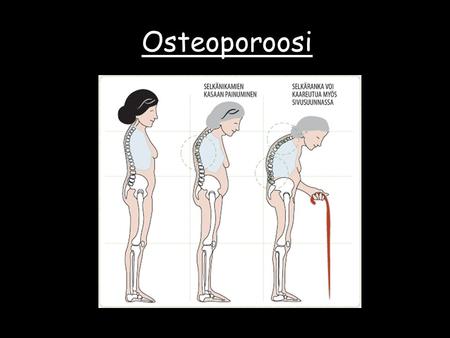 Osteoporoosi. Mikä on osteoporoosi? Osteoporoosi eli tunnetummalla nimellä luukato on Suomessa runsaslukuisena esiintyvä yleissairaus. Sairaus sekä tietyt.