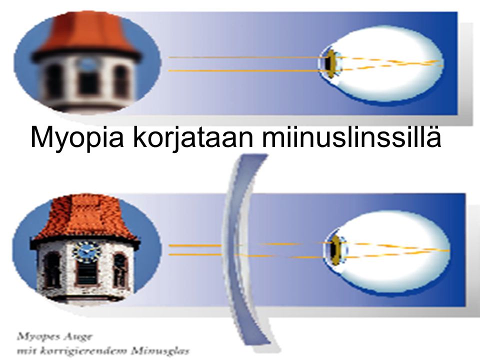Myopia korjataan miinuslinssillä