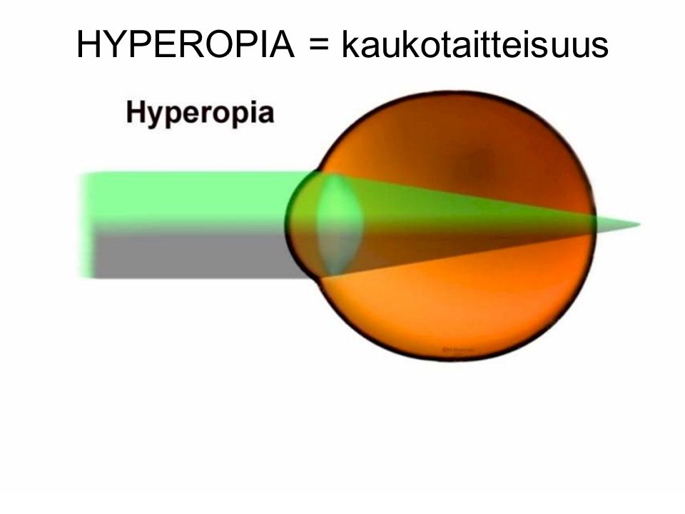 HYPEROPIA = kaukotaitteisuus