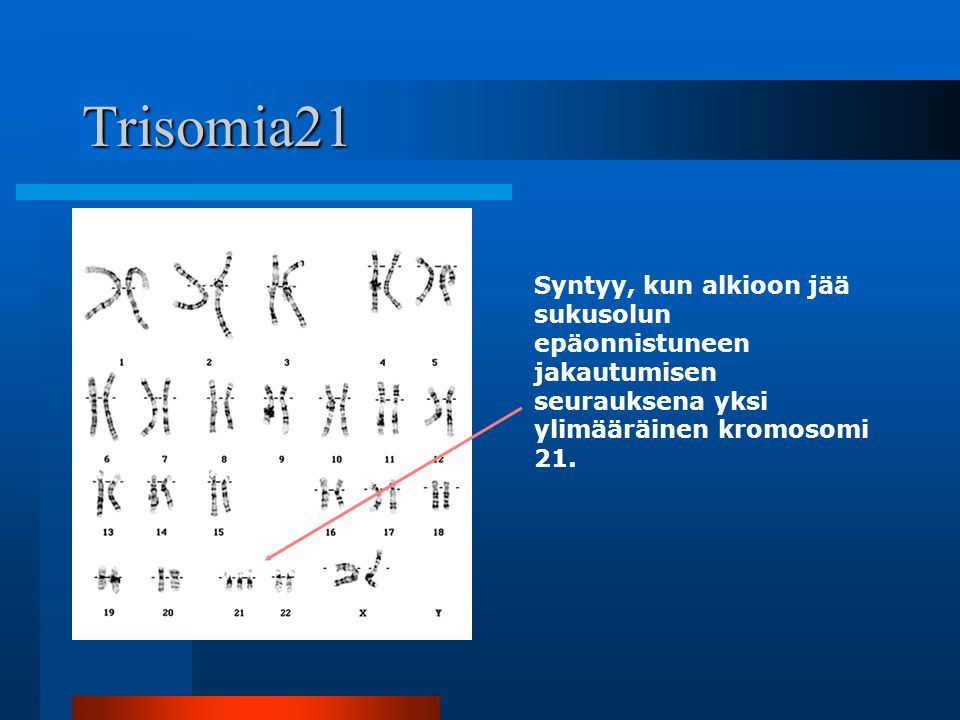 Trisomia21 Syntyy, kun alkioon jää sukusolun epäonnistuneen jakautumisen seurauksena yksi ylimääräinen kromosomi 21.