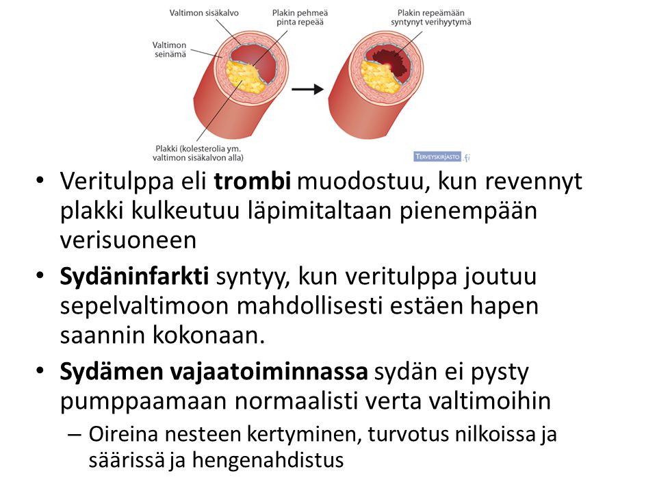 Veritulppa eli trombi muodostuu, kun revennyt plakki kulkeutuu läpimitaltaan pienempään verisuoneen
