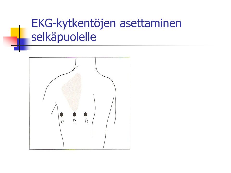 EKG-kytkentöjen asettaminen selkäpuolelle