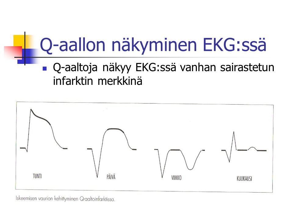 Q-aallon näkyminen EKG:ssä