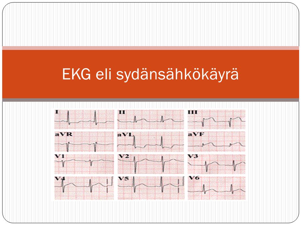 EKG eli sydänsähkökäyrä