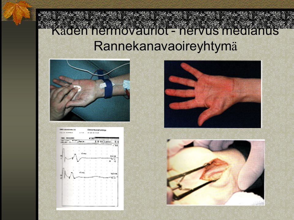 Käden hermovauriot - nervus medianus Rannekanavaoireyhtymä
