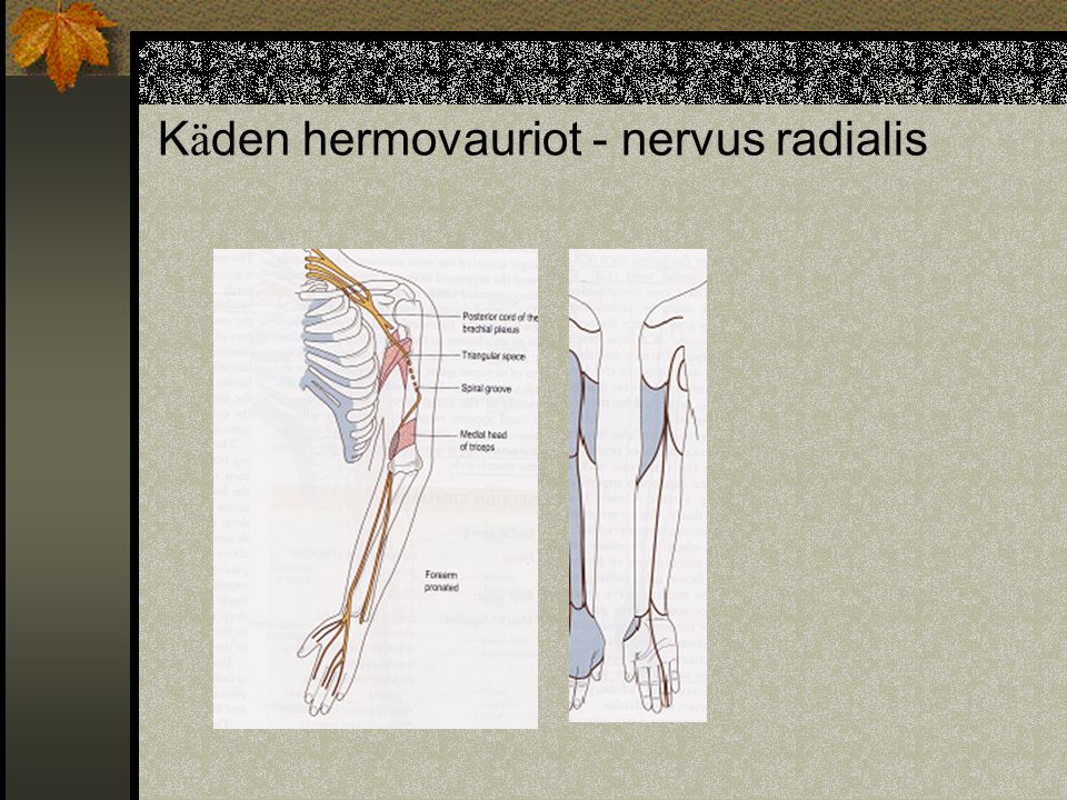 Käden hermovauriot - nervus radialis
