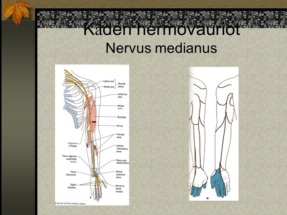 Käden hermovauriot Nervus medianus