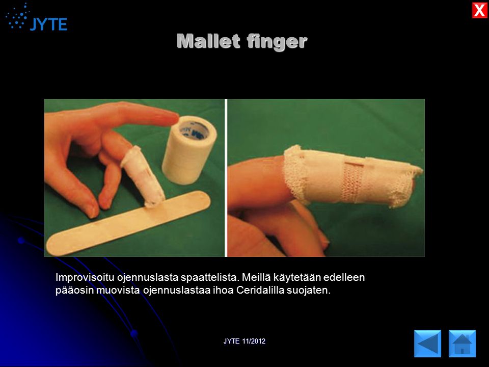 X Mallet finger. Improvisoitu ojennuslasta spaattelista. Meillä käytetään edelleen. pääosin muovista ojennuslastaa ihoa Ceridalilla suojaten.