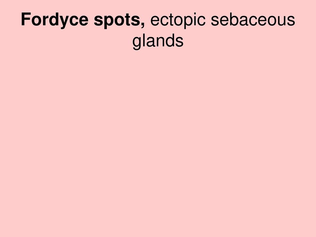 Fordyce spots, ectopic sebaceous glands