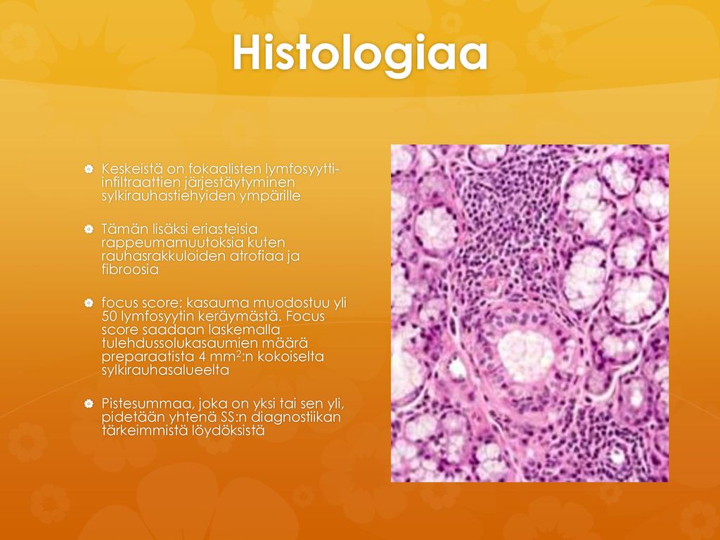 Histologiaa Keskeistä on fokaalisten lymfosyytti- infiltraattien järjestäytyminen sylkirauhastiehyiden ympärille.