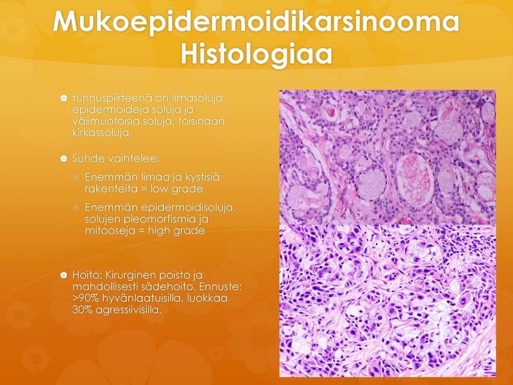Mukoepidermoidikarsinooma Histologiaa