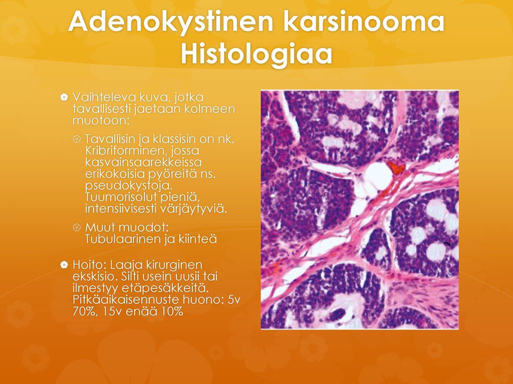 Adenokystinen karsinooma Histologiaa