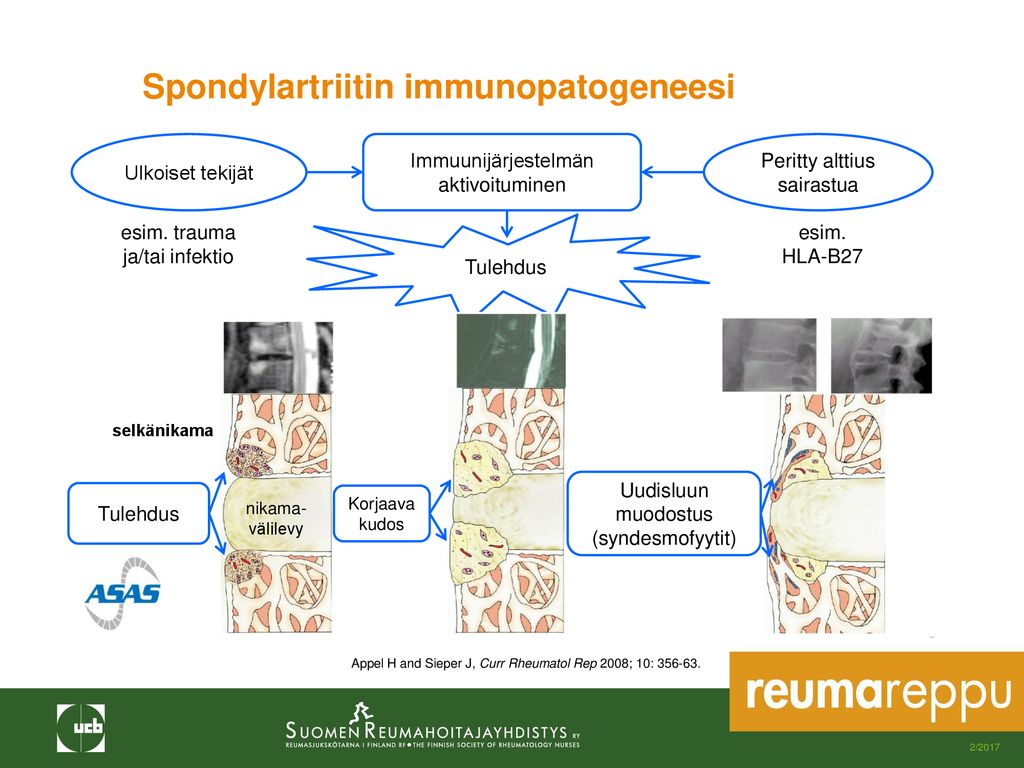 Spondylartriitin immunopatogeneesi