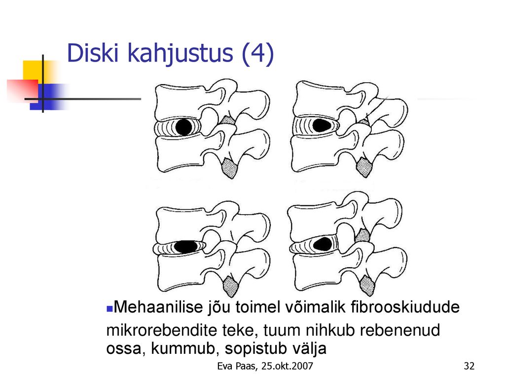 Diski kahjustus (4) Mehaanilise jõu toimel võimalik fibrooskiudude