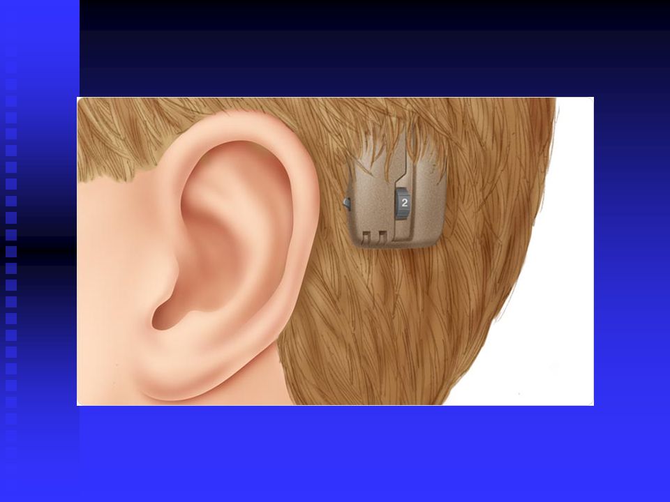 BAHAn audiologiset indikaatiot konduktiivisessa ja sekatyyppisessä kuulonalennuksessa: