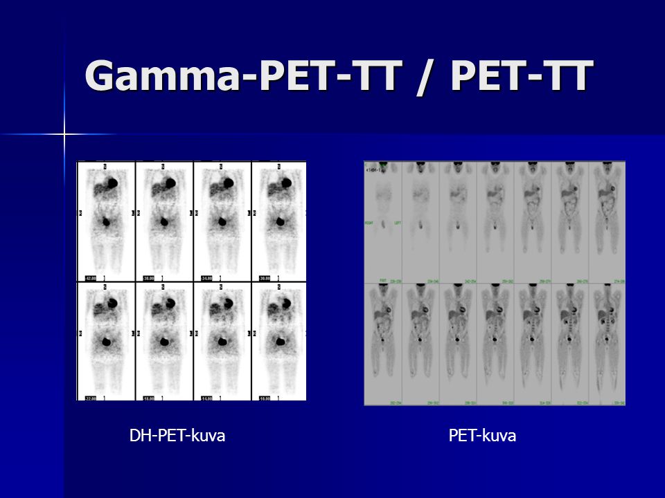 Gamma-PET-TT / PET-TT DH-PET-kuva PET-kuva