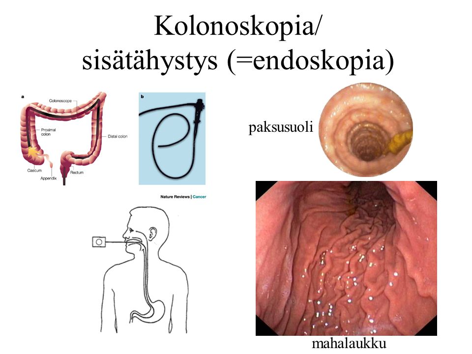 Kolonoskopia/ sisätähystys (=endoskopia)
