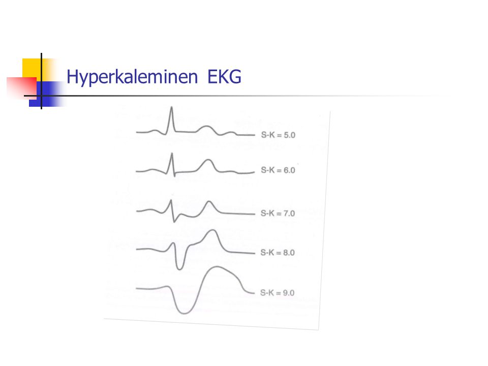 Hyperkaleminen EKG