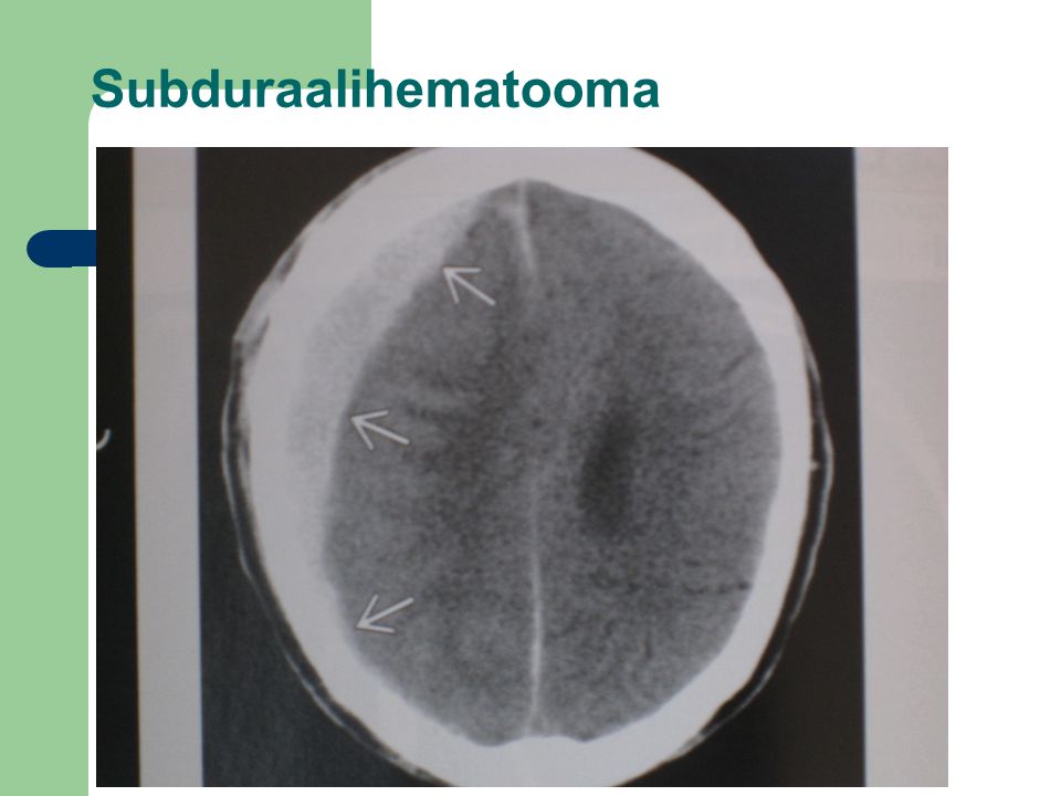 Subduraalihematooma