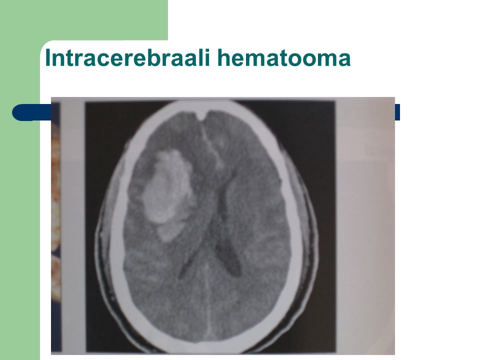 Intracerebraali hematooma