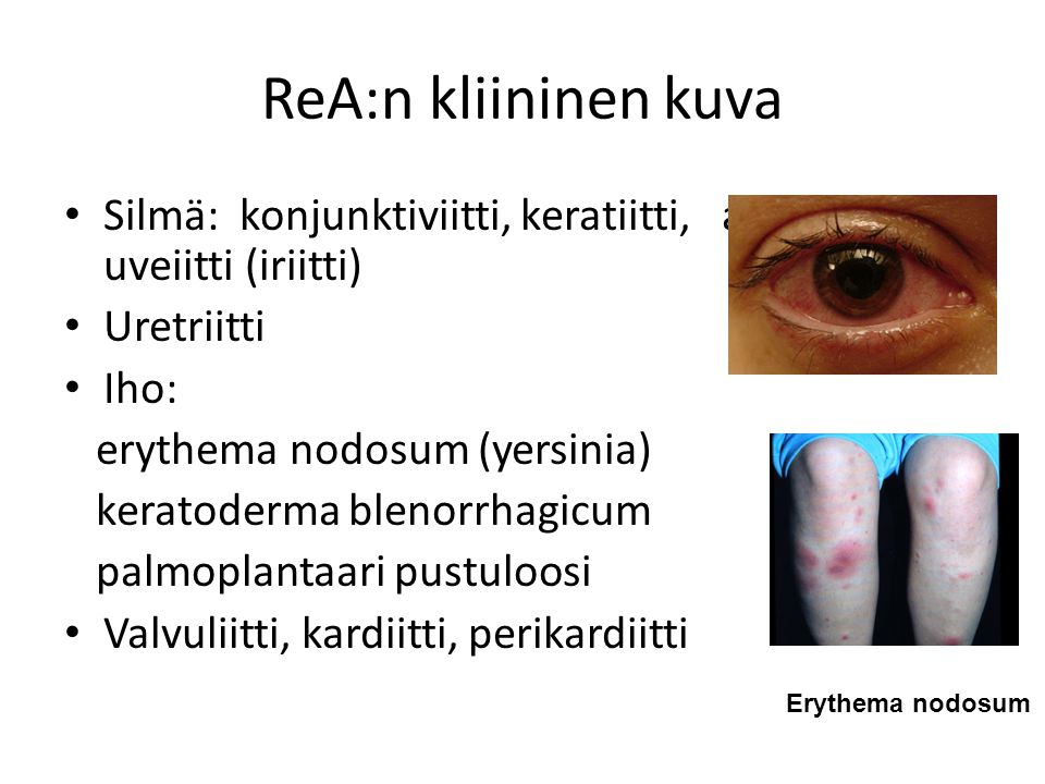 ReA:n kliininen kuva Silmä: konjunktiviitti, keratiitti, anteriorinen uveiitti (iriitti) Uretriitti.