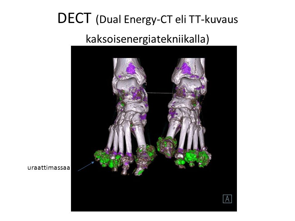 DECT (Dual Energy-CT eli TT-kuvaus kaksoisenergiatekniikalla)