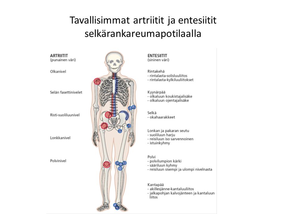 Tavallisimmat artriitit ja entesiitit selkärankareumapotilaalla