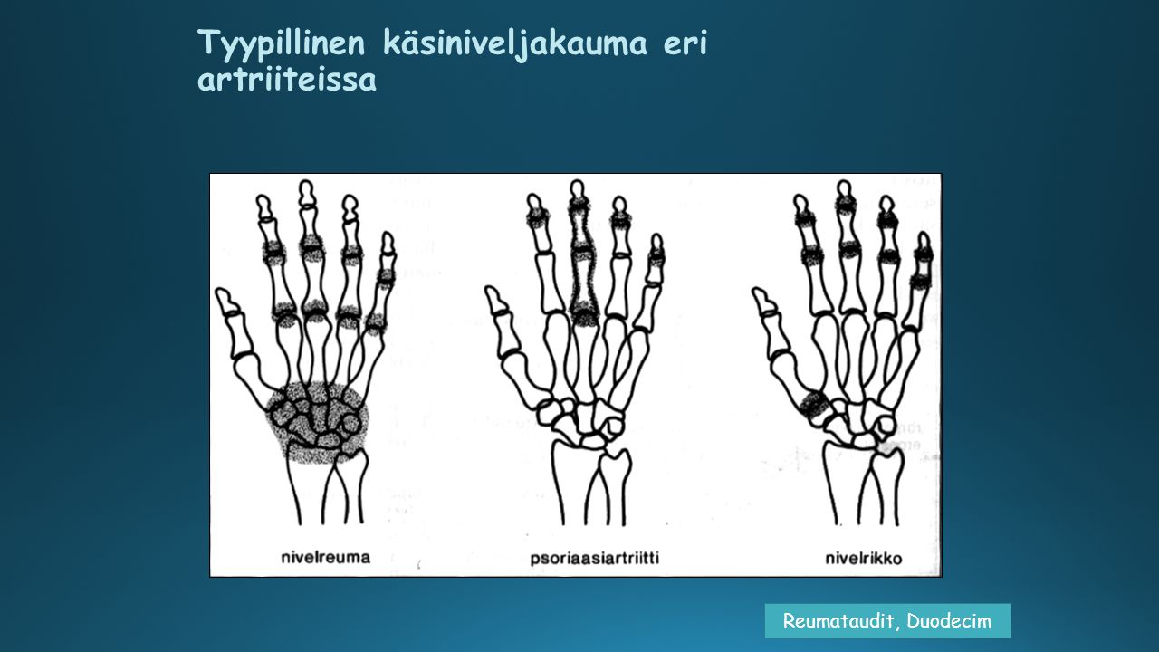 Tyypillinen käsiniveljakauma eri artriiteissa