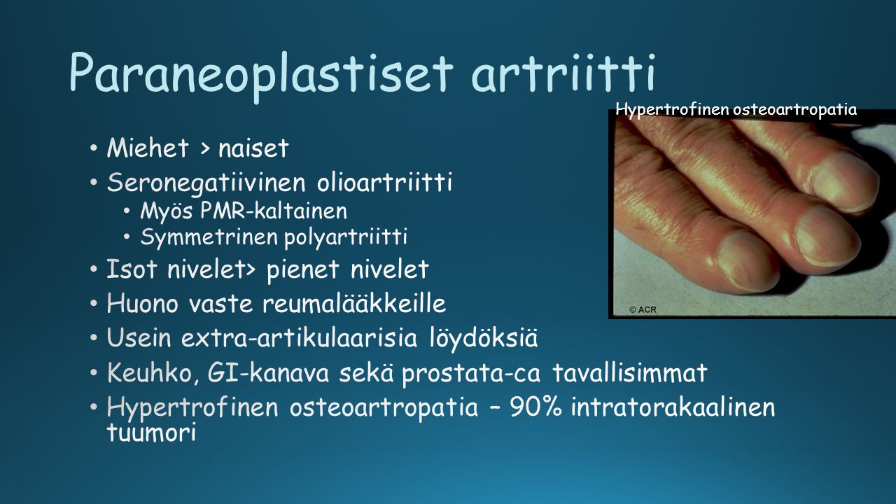 Paraneoplastiset artriitti